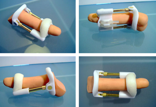 առնանդամի պահպանման պահպանողական մեթոդներ